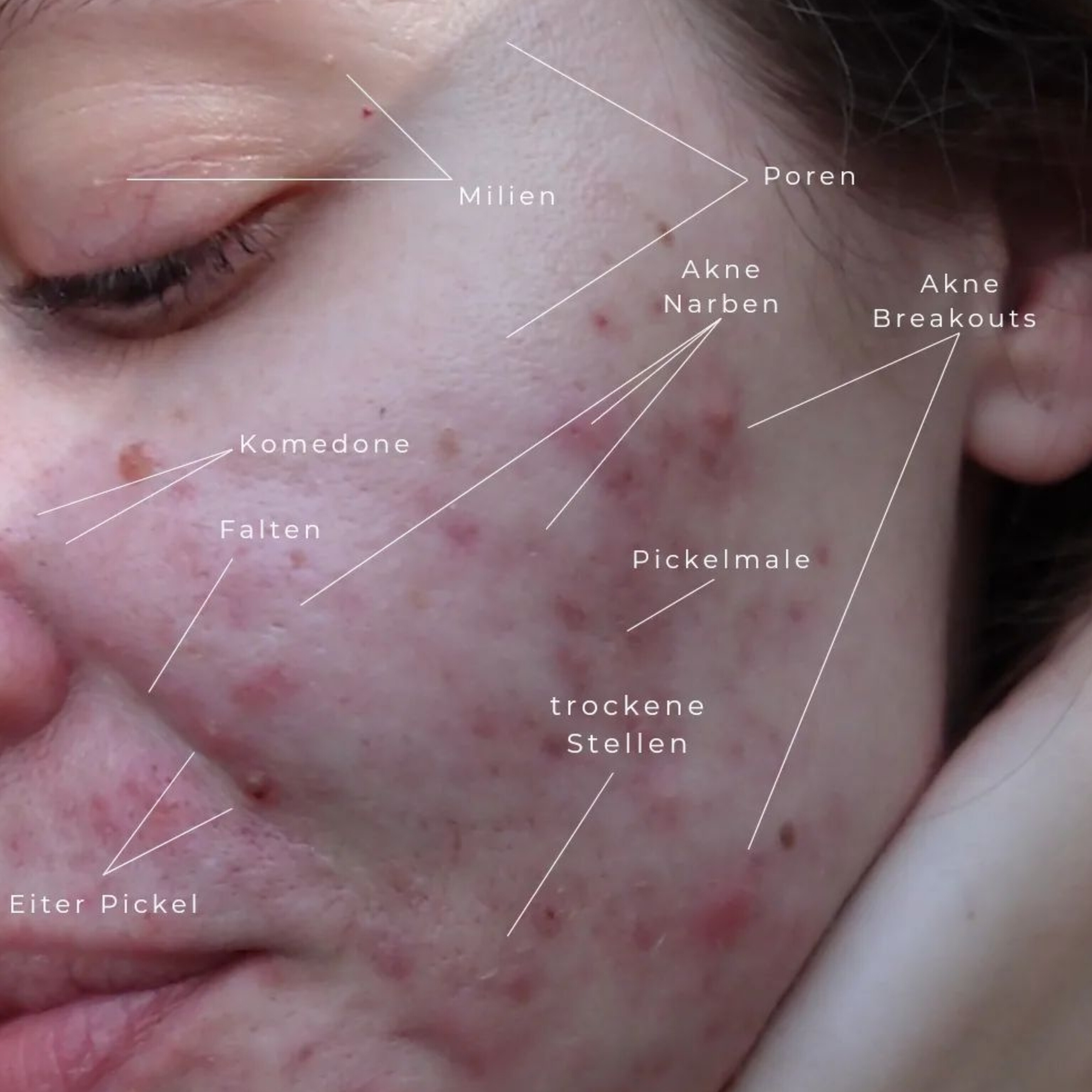 درمان فوری آکنه شدید