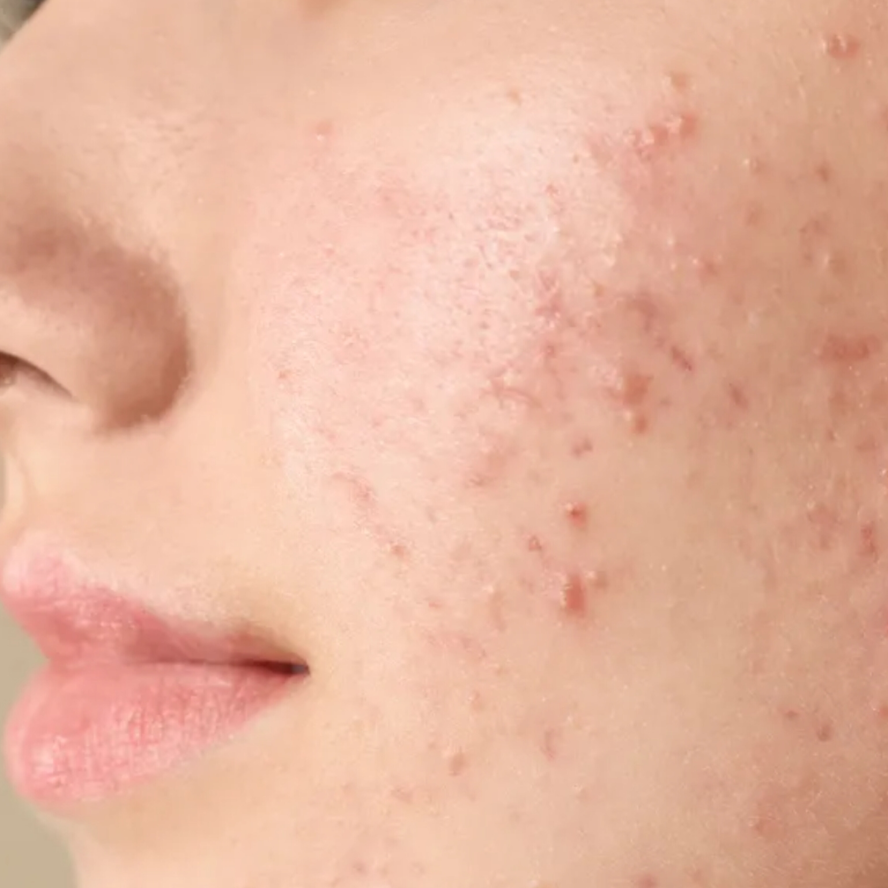 درمان جوش و آکنه با بنزوئیل پراکساید و معرفی چند محصول کاربردی و اقتصادی